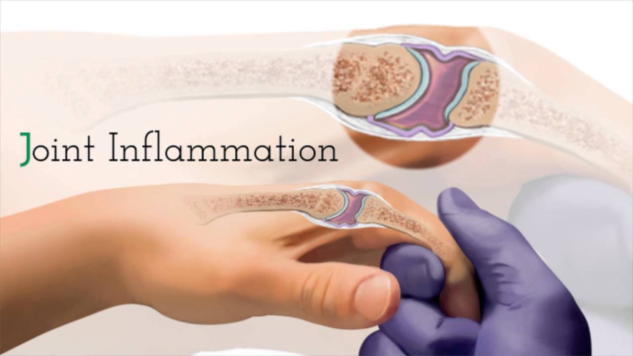 Cortisone Injection