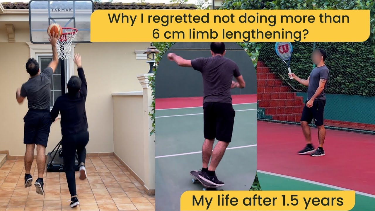Why I regretted not doing more than +6 cm limb lengthening? / My Life After 1,5 years