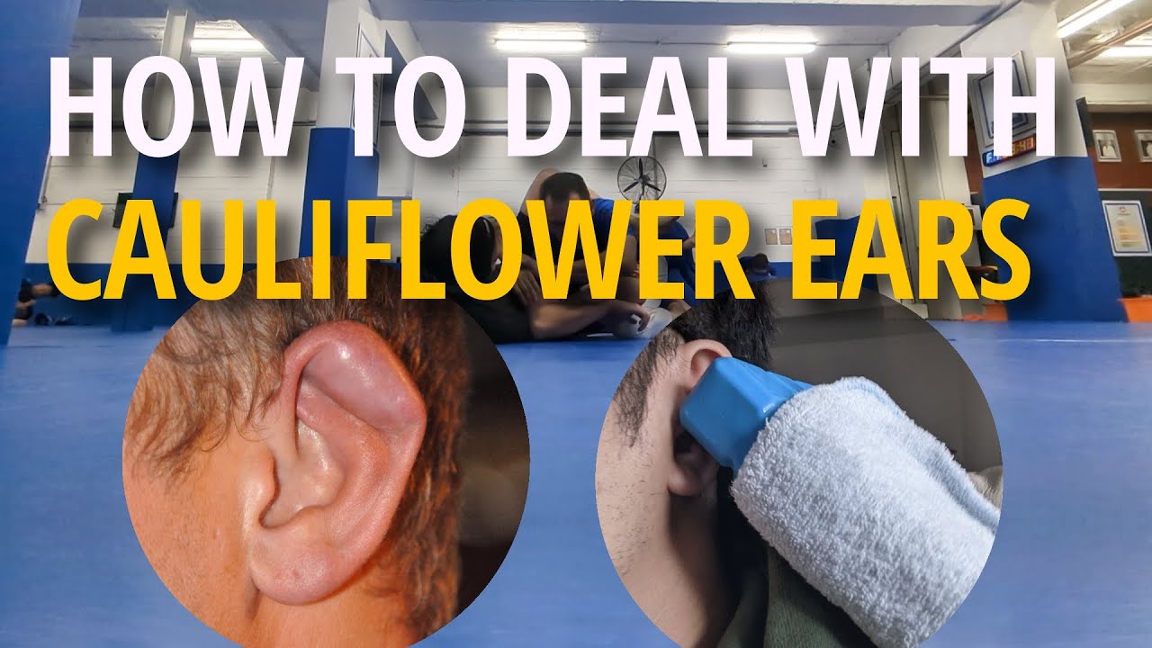 Guide on managing cauliflower ears | Jiu Jitsu Memoir