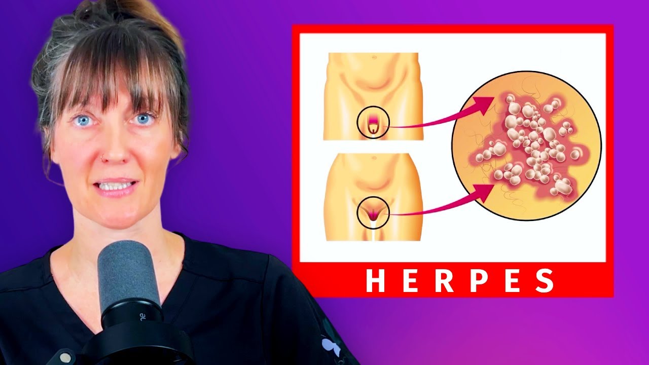 Herpes! 80% of People are Infected