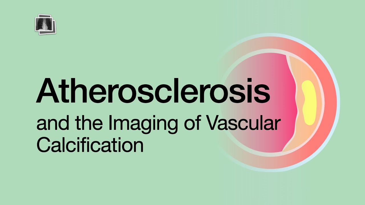 Atherosclerosis & the Imaging of Vascular Calcification