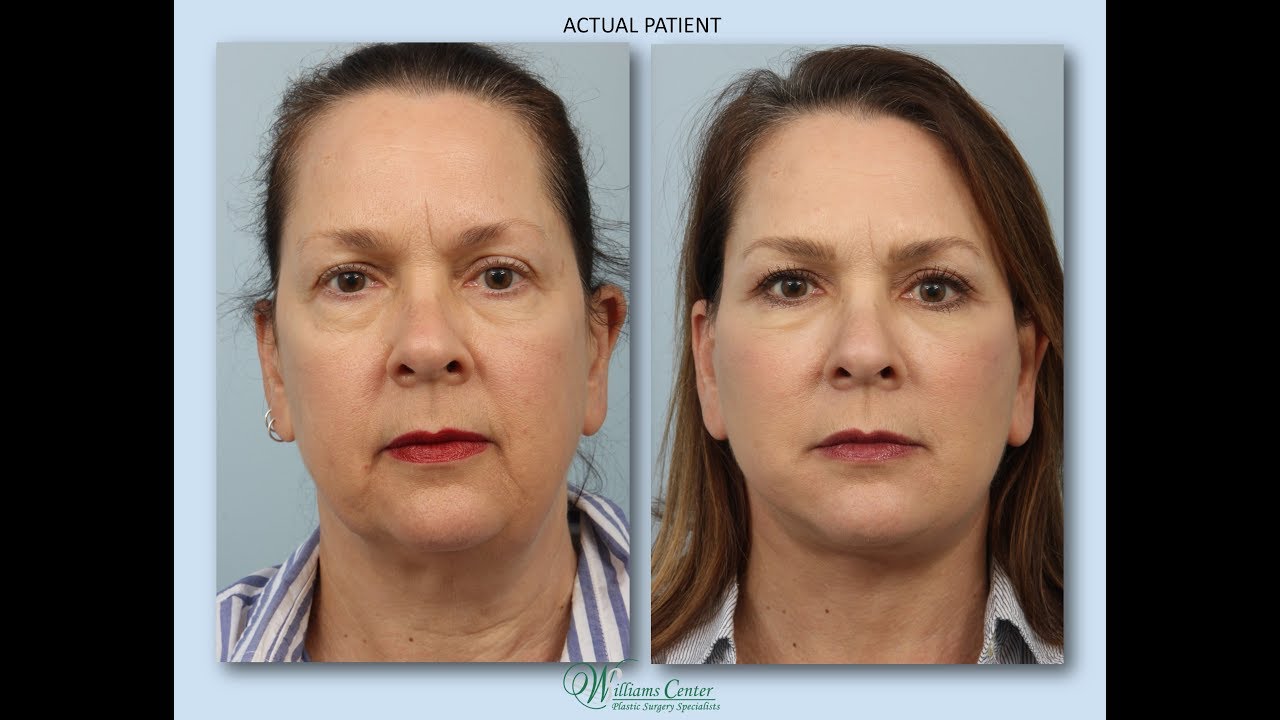 Natural Results Lower Facelift and Buccal Fat Removal By Dr. Edwin Williams