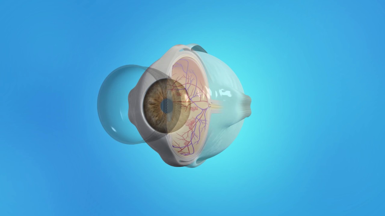 Retina Diabetic Proliferative Diabetic Retinopathy Laser
