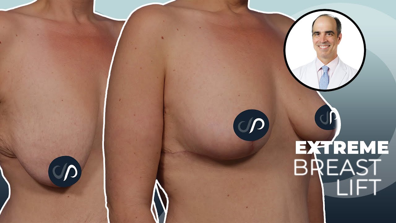 HUGE Breast Lift | Dr. David Stoker | Los Angeles, CA