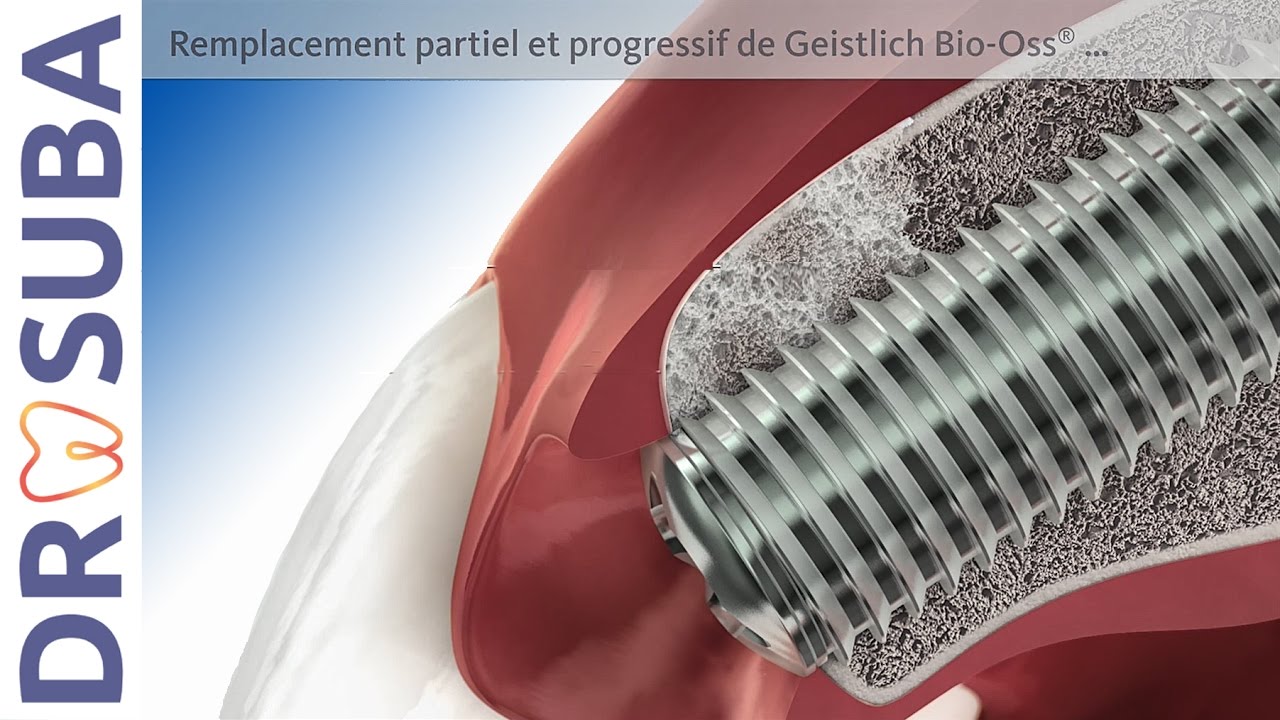 Greffe osseuse implant : Matériau comblement osseux - Dr SUBA Budapest