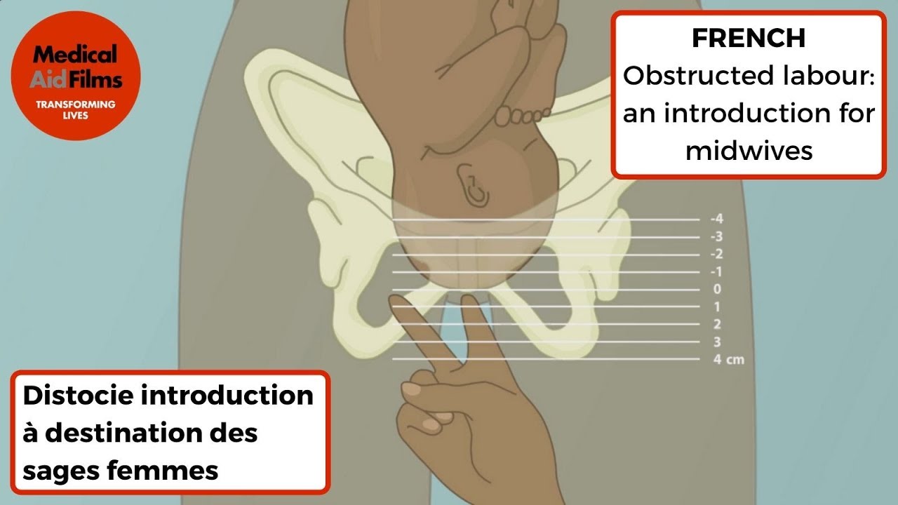 Distocie introduction à destination des sages femmes