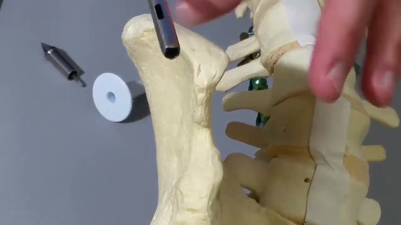 COREX&trade; | Percutaneous Iliac Crest Bone Harvesting (Anterior Approach On A Sawbone)