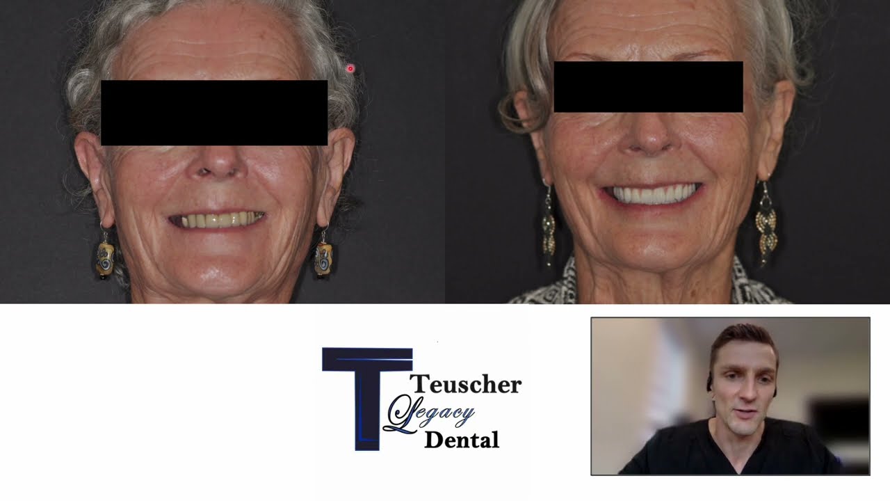 🦷 Immediate Load Implant Dentures | What Went Wrong 😬 & How We Fixed It ✅ (Full Case Voiceover)