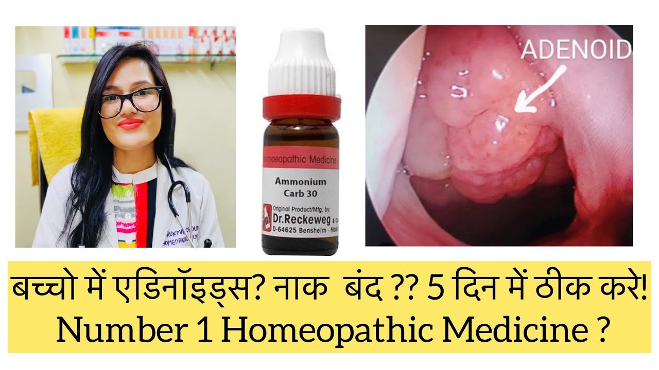 बच्चो में नाक बंद ? एडिनॉइड्स को बिना ऑपरेशन के ठीक करे? Adenoids Best Homeopathic Medicines?