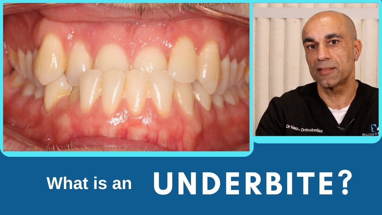 How to Fix Underbite with Braces or Invisalign®?