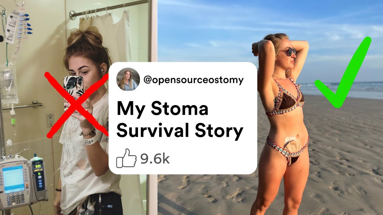 My Ostomy Story | Colitis, Crohn’s, Surgery & Getting My Life Back