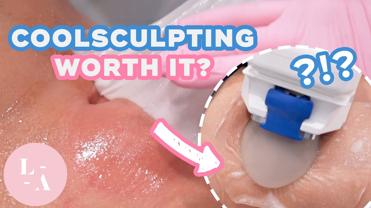 My Coolsculpting Experience - Was it Worth it? Before and After with Ireland Borba - LaserAway