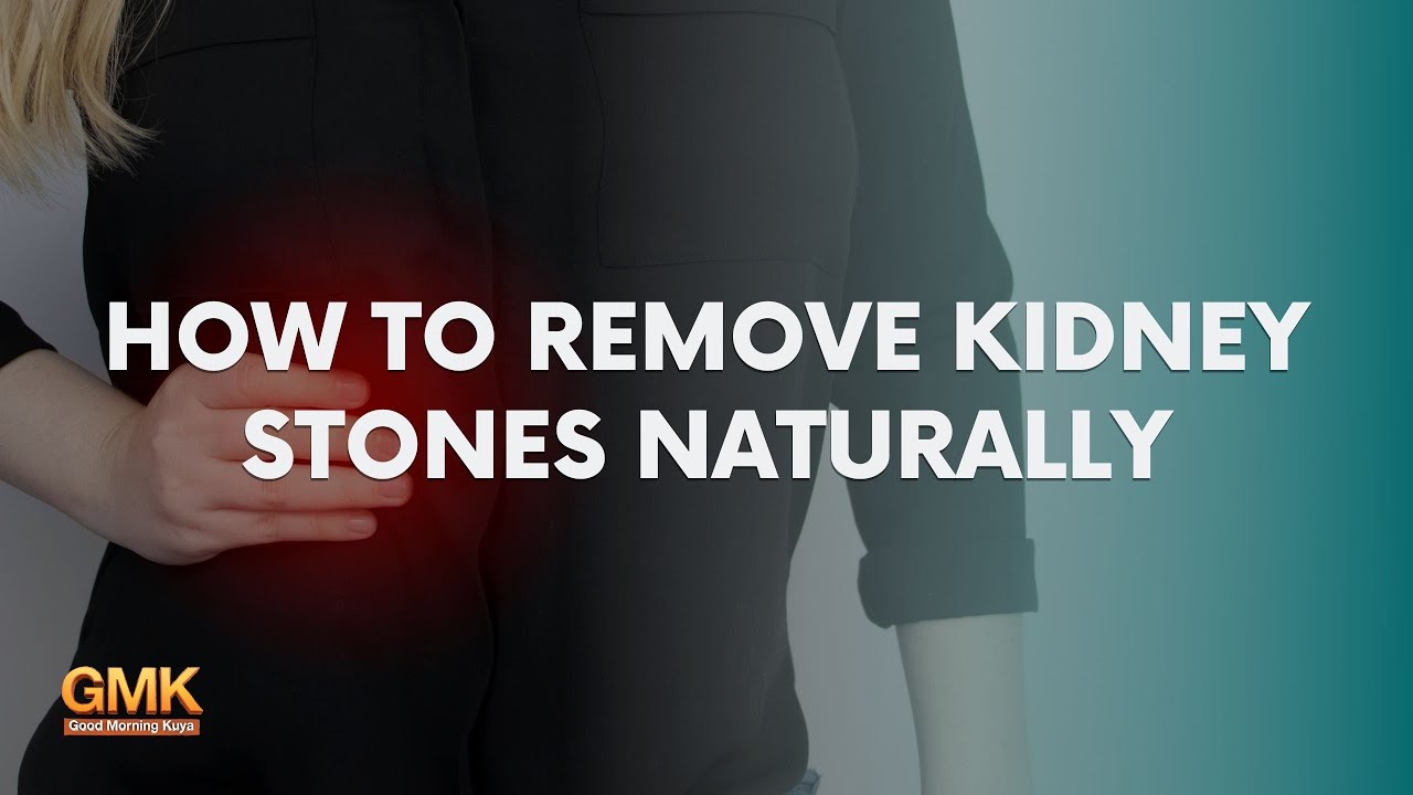 How to Remove Kidney Stones Naturally (Part 3) | Usapang Pangkalusugan