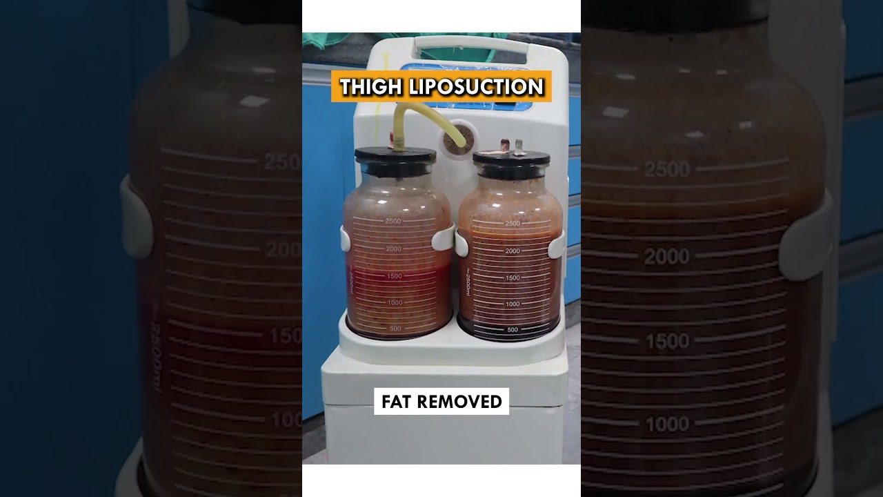 Thigh Liposuction Surgery - Details, What to expect and Before & After results! #liposuction #shorts