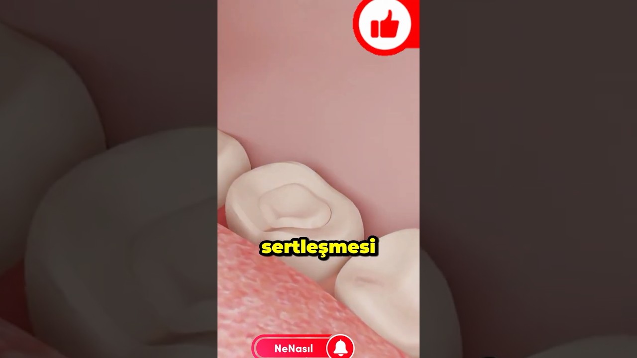 &Ccedil;&uuml;r&uuml;k Dişe Nasıl Dolgu Yapılır? | Cam İyonomer & Mikromotor Nedir?