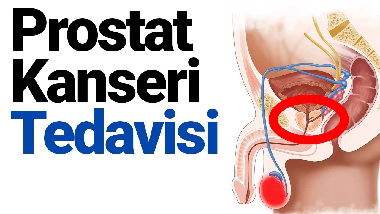 Prostat Kanseri Tedavisi Nasıl Yapılır
