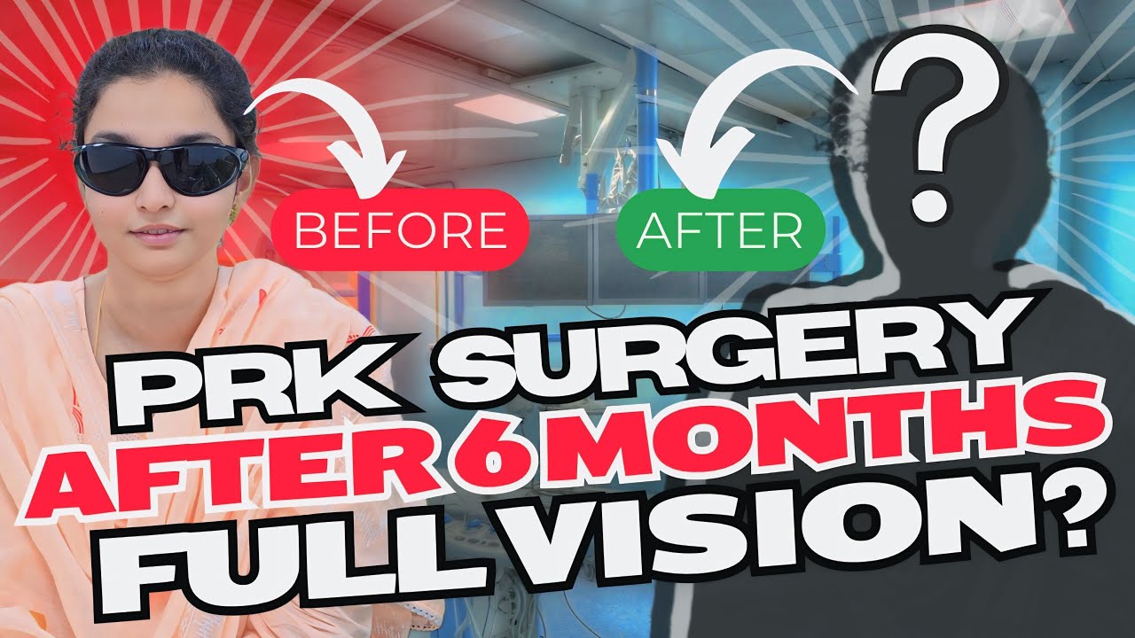My Eyes and Vision, 6 Months After PRK Eye Surgery | SumiiTalks