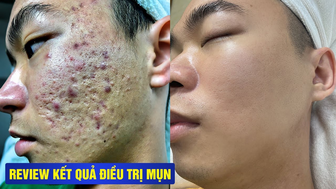 TRỊ MỤN 1 LẦN &ndash; DA ĐẸP SUỐT 6 NĂM, KH&Ocirc;NG T&Aacute;I PH&Aacute;T - TẠI PH&Ograve;NG KH&Aacute;M DA LIỄU HHV CLINIC.
