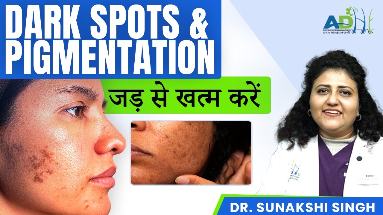 Pigmentation क्यों होता है? Melasma, Dark Spots & Uneven Skin Tone | Dr. Sunakshi Singh (ADHT)