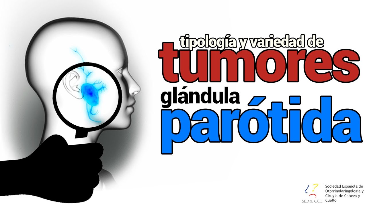 Tumores en la glándula parótida (cáncer de glándulas salivales)  - SEORL CCC