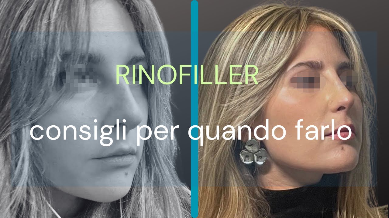 Caso di RINOFILLER (e consigli per quando farlo)