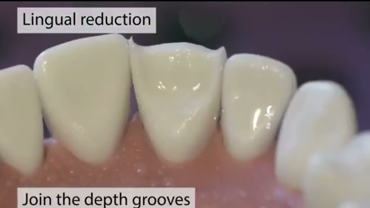 Preparasi Bridge / Jembatan gigi All Ceramic Zirconia crown / Porcelain crown