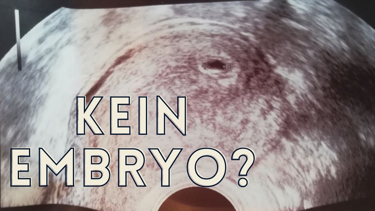 Mein Schwangerschaftsverlust | 8. SSW | Fruchtblase ohne Embryo (WITH ENGLISH/GERMAN SUBTITLES)
