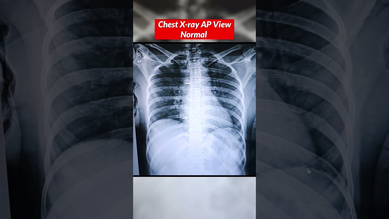 Chest X-ray Normal vs Fracture ⚡️Ribs Fracture #chestxray #xray #fracture #bones