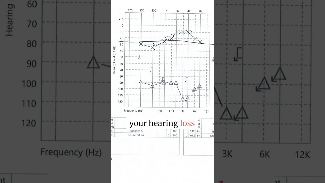 First formal hearing test after #ramsayhuntsyndrome #hearingloss