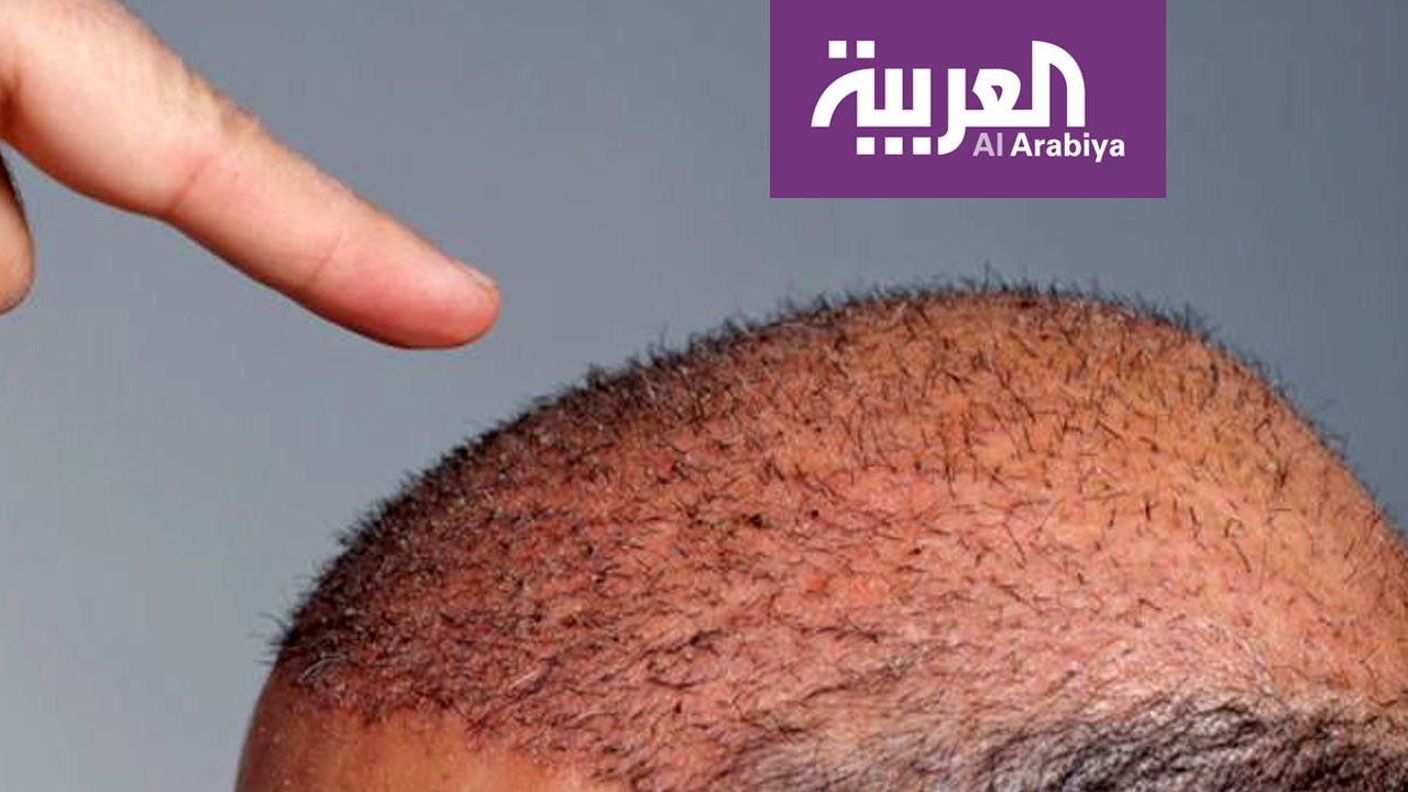 صباح العربية: تقنية جديدة لزراعة الشعر دون جراحة