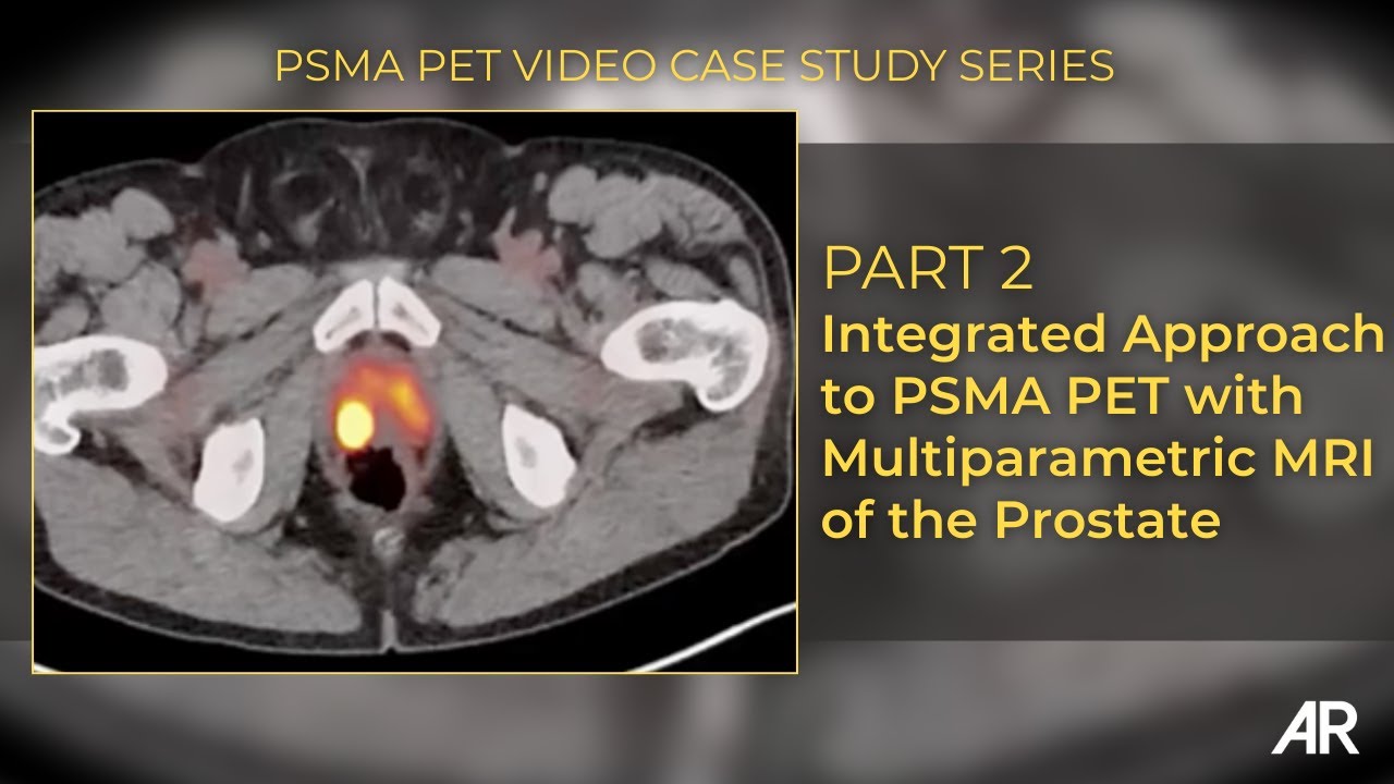 Part 2 | Integrated Approach to PSMA PET with Multiparametric MRI of the Prostate