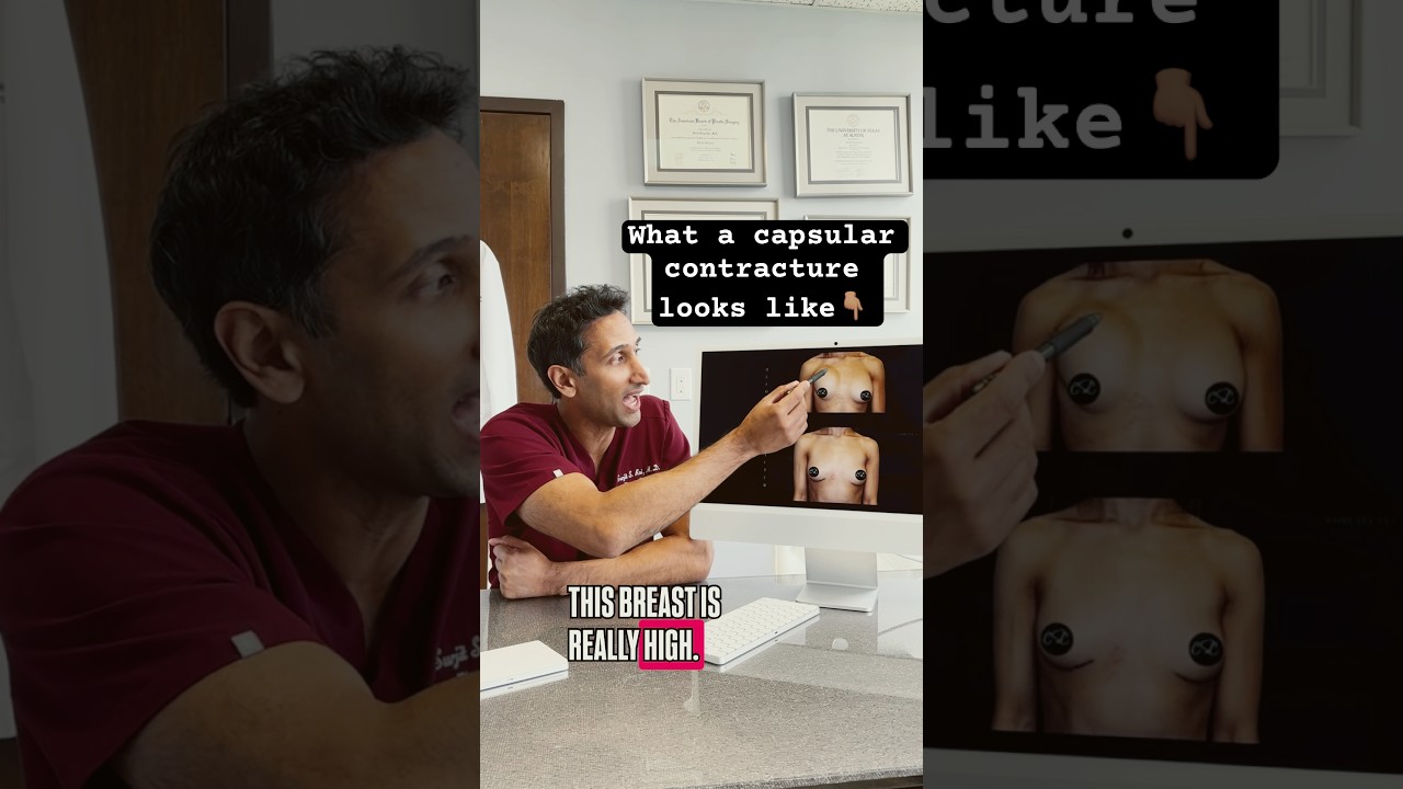 What a capsular contracture looks like #breastexplant #explantsurgery #plasticsurgeon