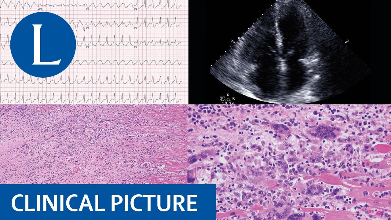 Giant cell myocarditis presents with arrhythmias