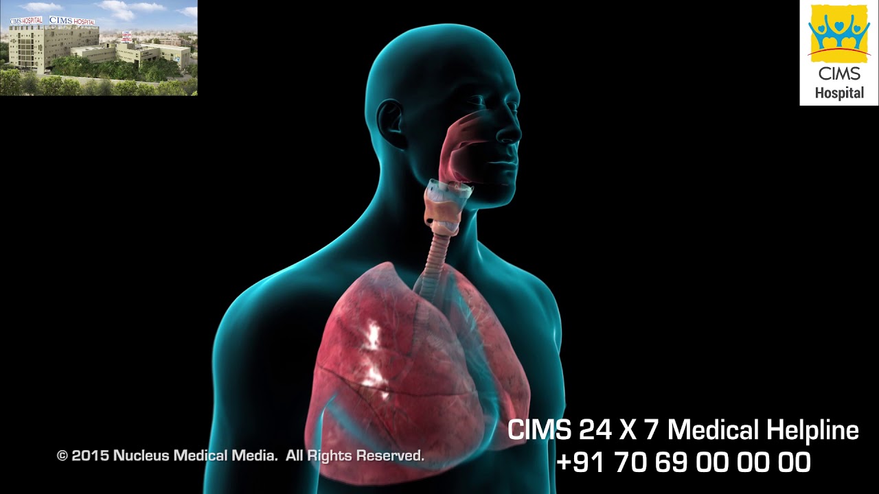 Bronchoscopy (Hindi) - CIMS Hospital