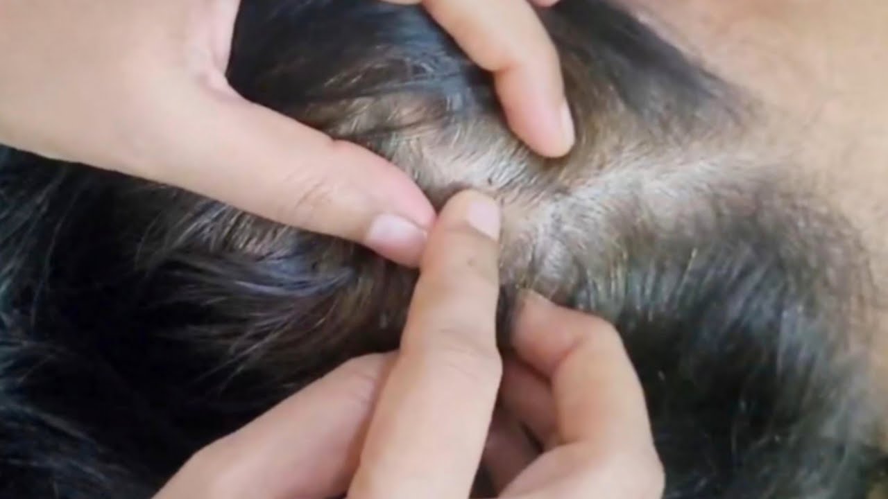 ASMR ✨ 💫 Detailed Scalp Check and Lice Check Removal ( Real Person)😴#asmr #sleep #satisfying