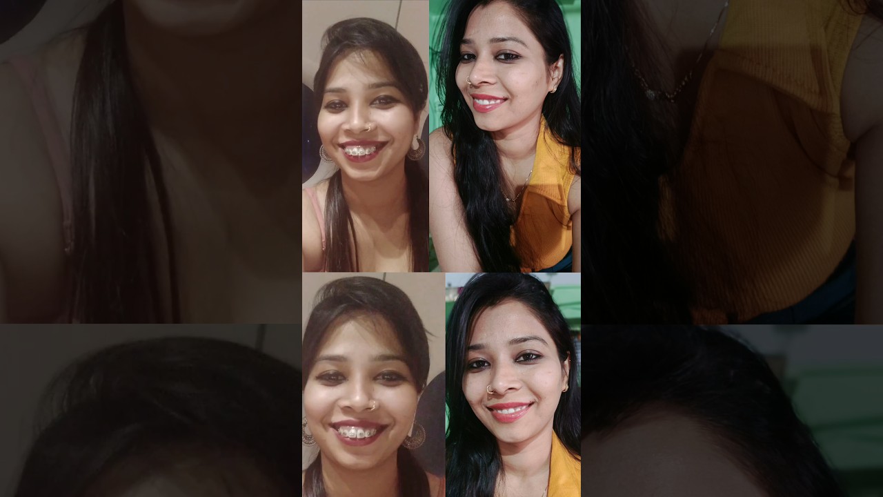 My complete braces journey// Before and after look #braces #bracestreatment #shorts