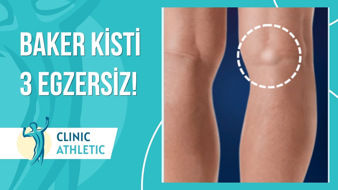 Baker Kisti Nedir? 3 Kolay Egzersiz!