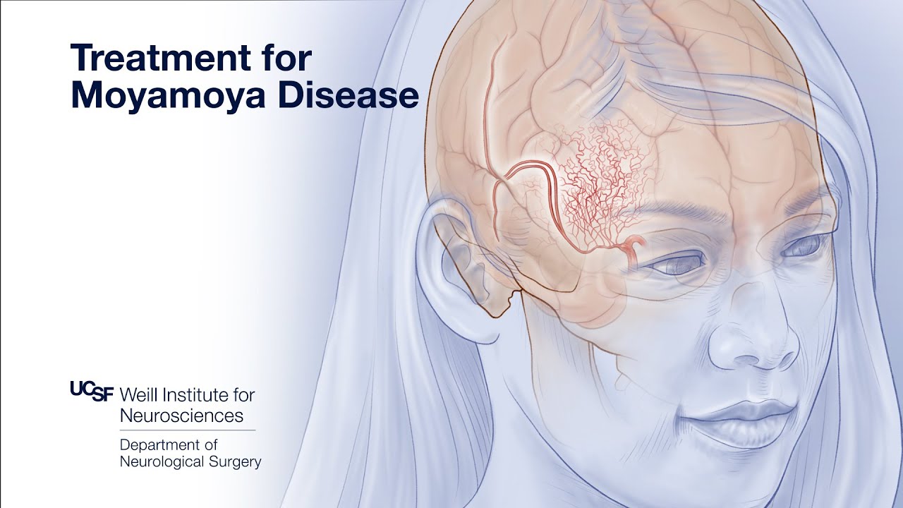 Treatment for Moyamoya Disease | UCSF Comprehensive Stroke Center