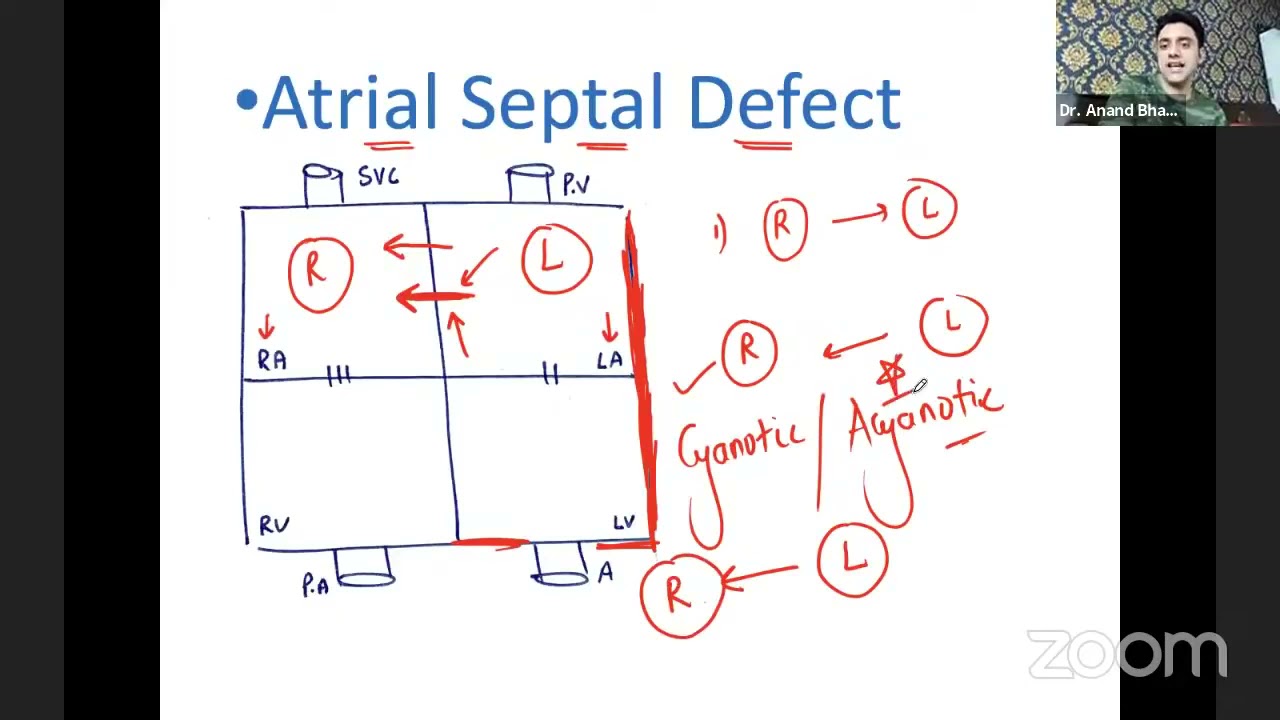 Pediatric Cardiology By Dr.Anand - Atrial Septal Defect #pediatricsbydranand