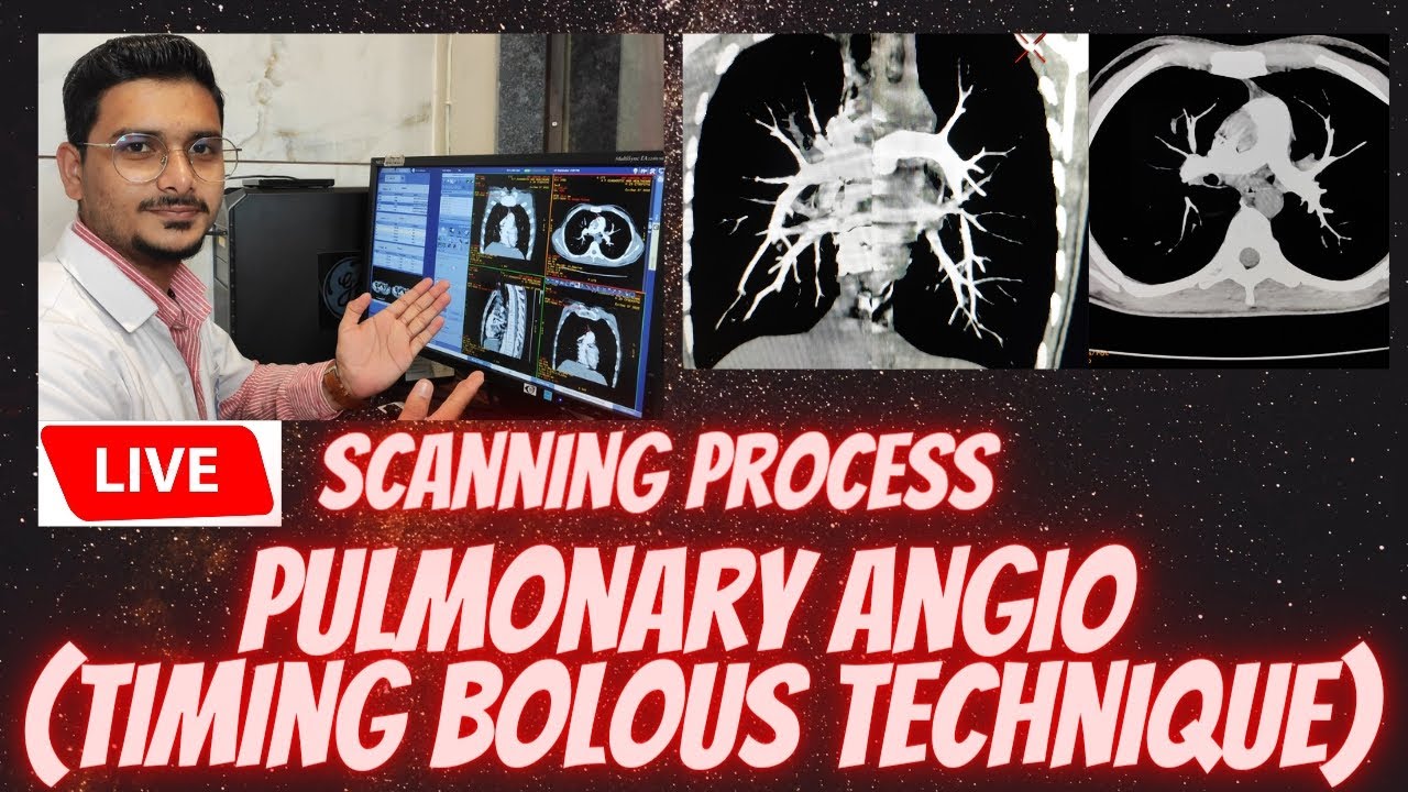 Pulmonary Angiography (timing bolous technique) | live scanning process of pulmonary angio