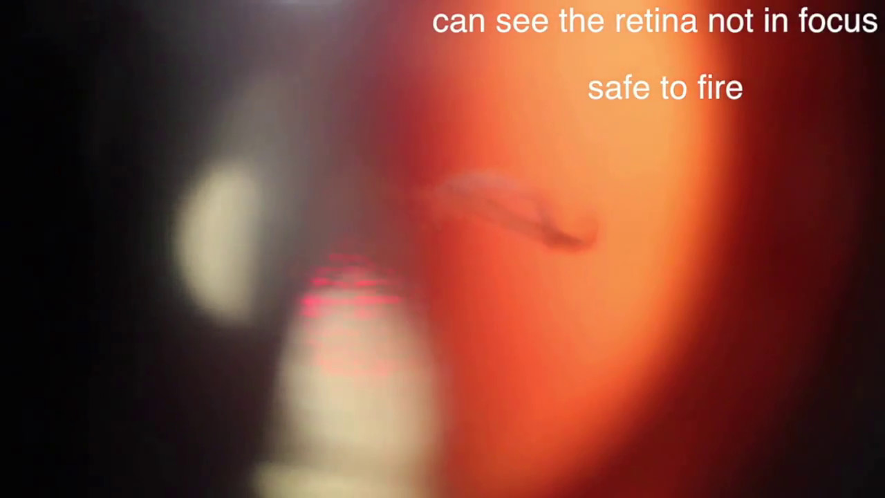 Laser Treatment Through a Multi-Focal Lens