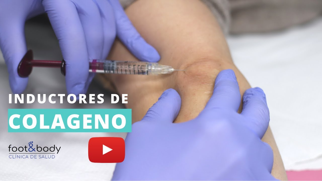 Inductores de Colágeno - Hilos tensores, Radiesse y Ellansse ¿Qué son?