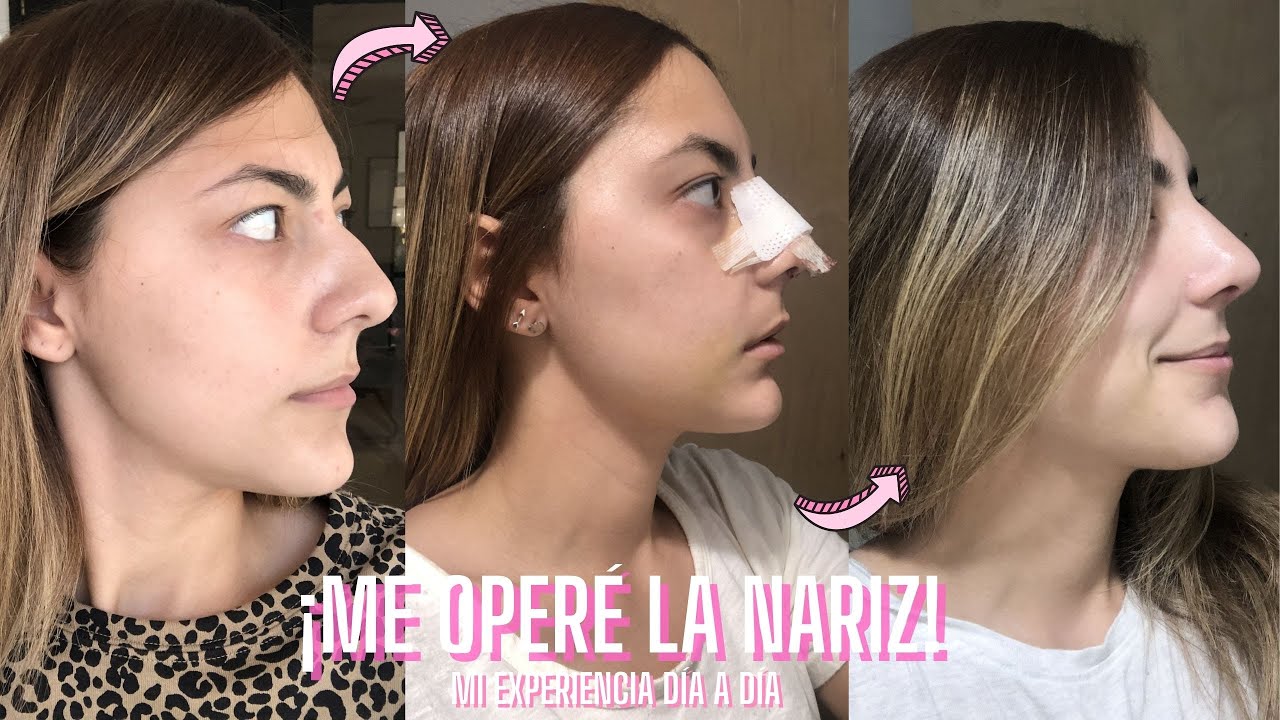 ¡ME OPERÉ LA NARIZ! - Mi rinoplastia día a día, lo que nadie te muestra