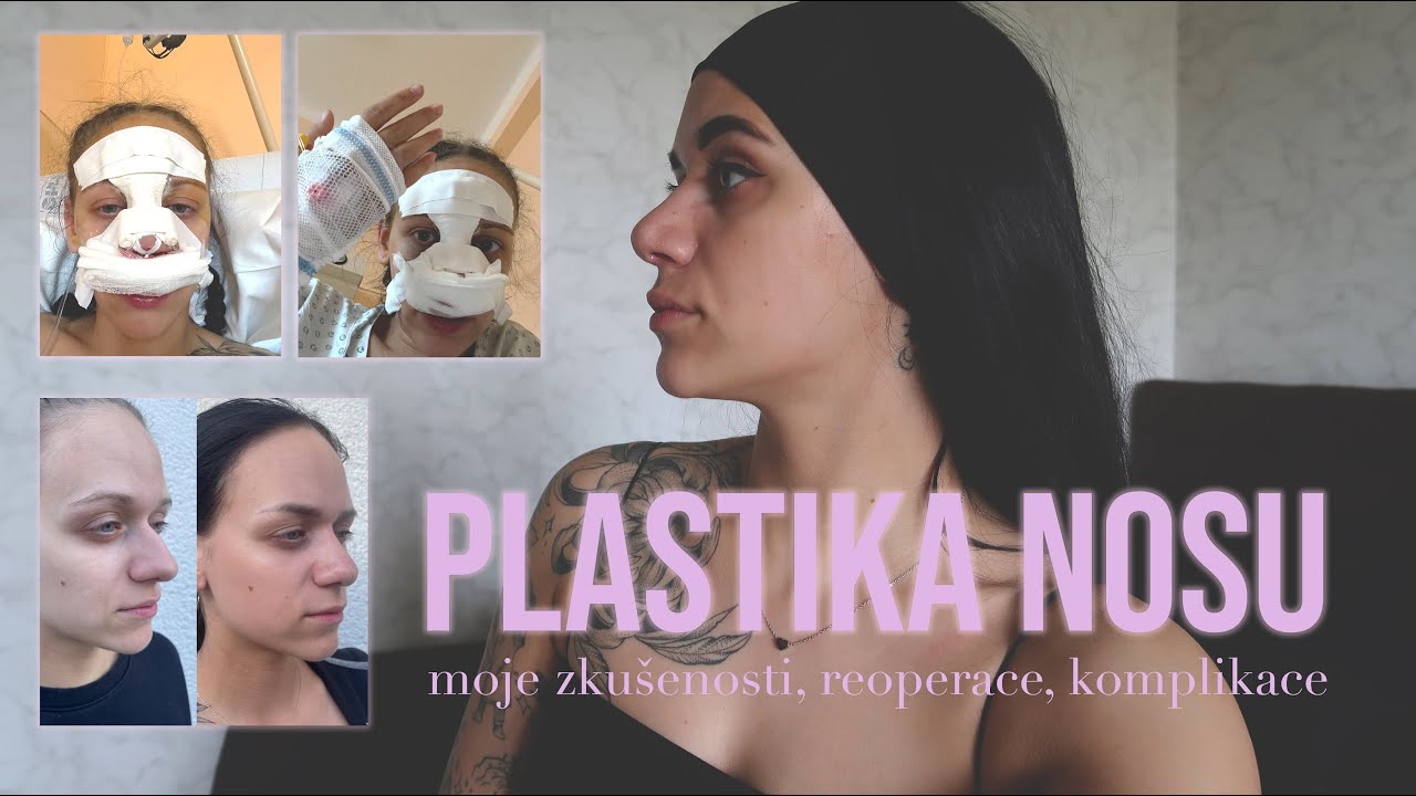 NEPOVEDEN&Aacute; PLASTIKA NOSU? | reoperace, zku&scaron;enosti, rady & tipy