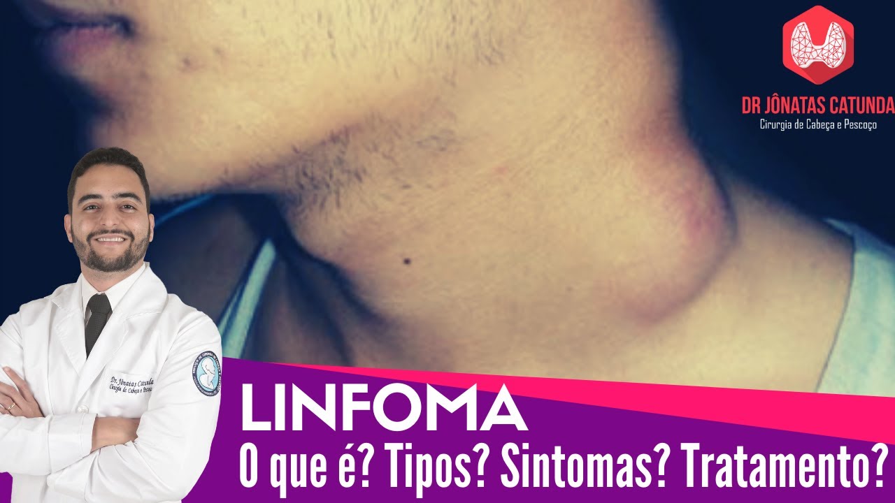 O que é Linfoma? Tipos de linfoma, Sintomas, Tratamento - Dr Jônatas Catunda