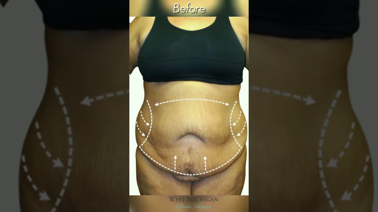 Tummy Tuck RESULTS #mommymakeover #beforeandafter #shorts