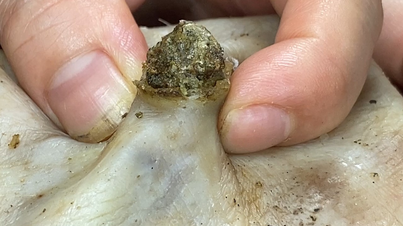 🔴LIVE Professional Pedicure Sharp Ingrown Trimmed! DR LEE&rsquo;S ULTIMATE ZITPOPPER