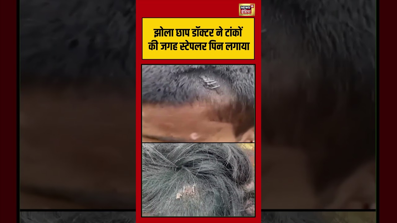 Bihar News: डॉक्टर ने टांकों की जगह Stapler Pin लगाया #shorts #viralnews #viralvideo #bihar #nawada