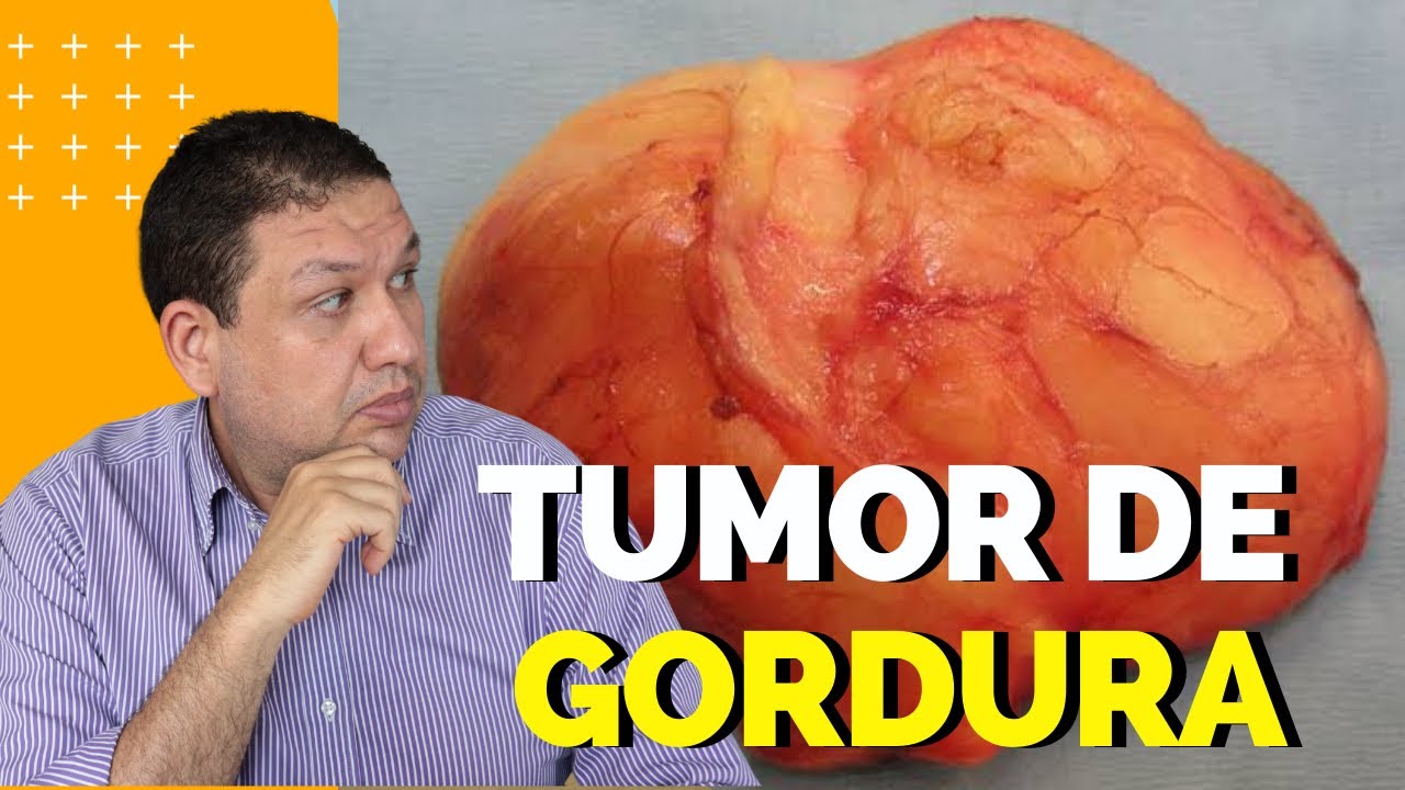 TUMOR DE GORDURA, LIPOMA, É MAIS COMUM DO QUE SE PENSA!! O que é lipoma e o Tratamento do lipoma.