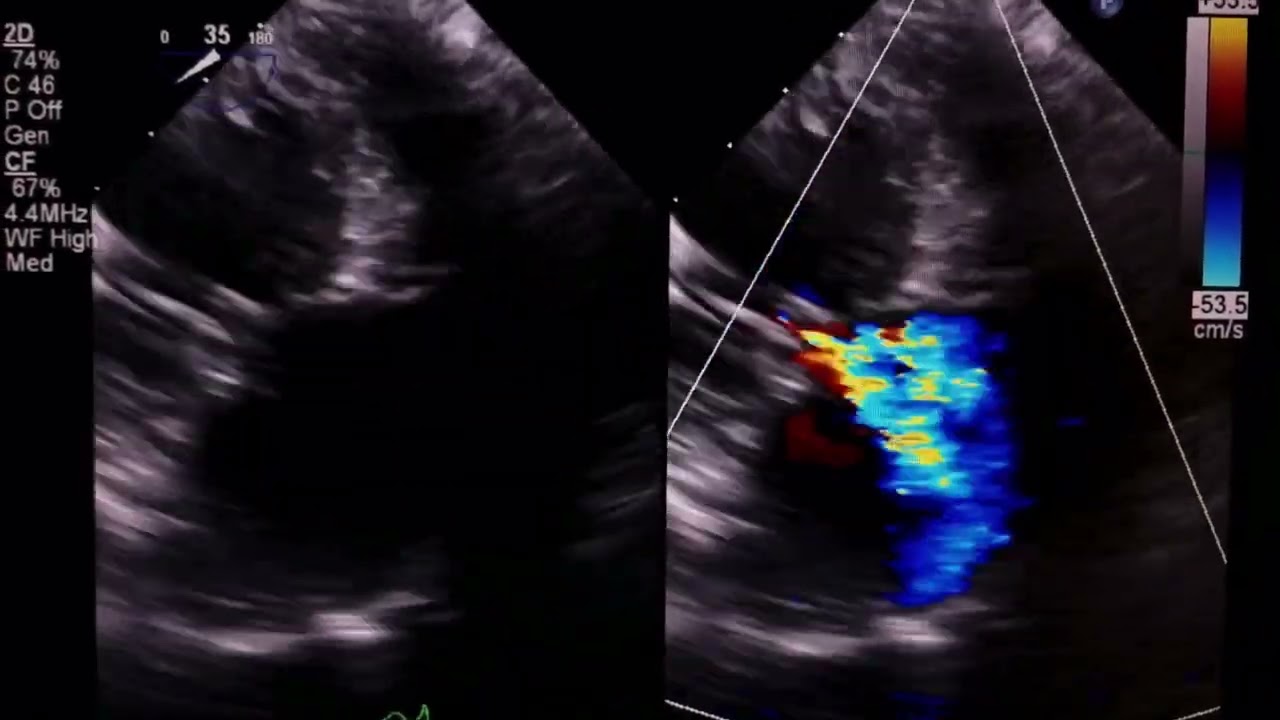 3D TEE case of Mixed pathology of Ischemic & Rheumatic functional MR